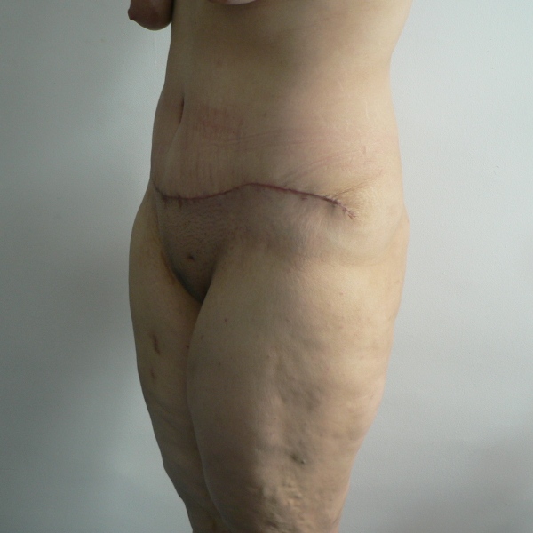 abdomino caz13-post2