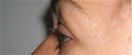 blefaroplastie caz1-pre1