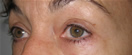 blefaroplastie caz1-pre2