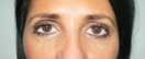 blefaroplastie caz10-post1