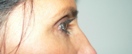 blefaroplastie caz10-post3