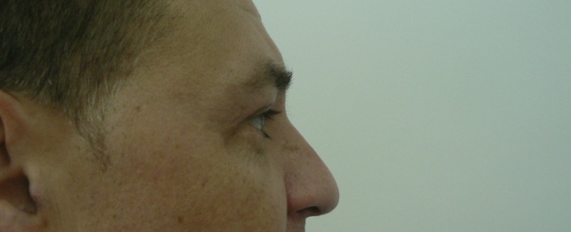 blefaroplastie caz11-post2