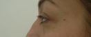 blefaroplastie caz14-pre2