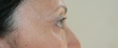 blefaroplastie caz15-post3