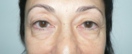 blefaroplastie caz15-pre1