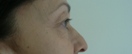 blefaroplastie caz15-pre3