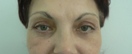 blefaroplastie caz17-post1