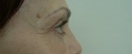 blefaroplastie caz17-post3