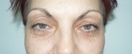 blefaroplastie caz17-pre1