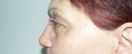 blefaroplastie caz17-pre2