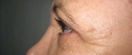 blefaroplastie caz2-post2