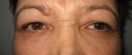 blefaroplastie caz2-pre1