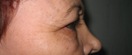 blefaroplastie caz2-pre3