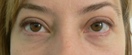 blefaroplastie caz4-post1