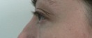 blefaroplastie caz4-post2