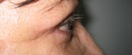 blefaroplastie caz6-post3