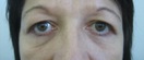 blefaroplastie caz6-pre1