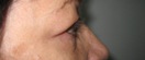 blefaroplastie caz6-pre3
