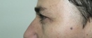 blefaroplastie caz7-post2