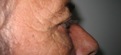 blefaroplastie caz8-post3