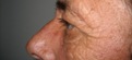 blefaroplastie caz8-pre2