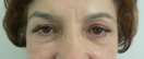blefaroplastie caz9-post1