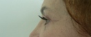 blefaroplastie caz9-post2