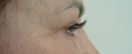 blefaroplastie caz9-post3