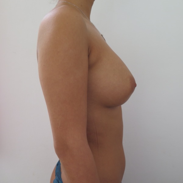 augmentare caz35-post3