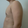 ginecomastie caz12-post3