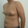 ginecomastie caz12-pre2