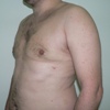 ginecomastie caz17-post2