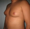 ginecomastie caz2-pre3