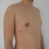 ginecomastie caz4-post2