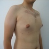 ginecomastie caz6-pre2