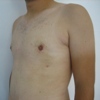 ginecomastie caz7-post2