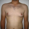 ginecomastie caz7-pre1