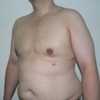 ginecomastie caz8-post2