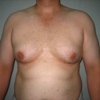 ginecomastie caz8-pre1