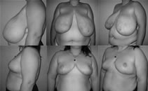 detalii gigantomastie(reductie) caz#1